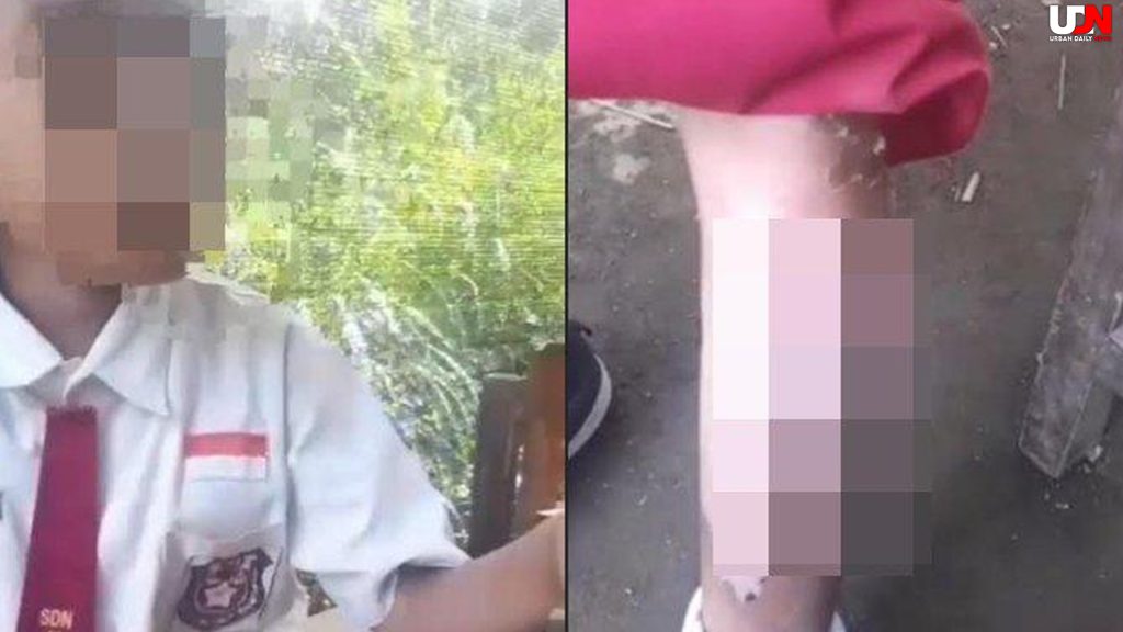Bocah Jember Disiram Kuah Bakso Panas, Kekerasan Terungkap